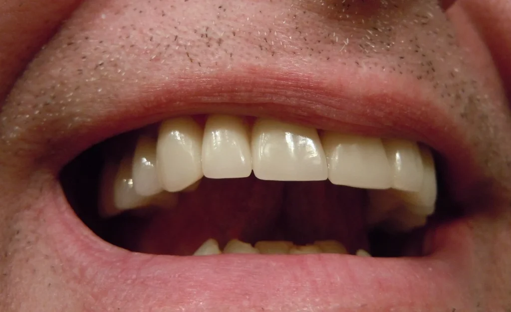 Was bedeutet es, von Zähne zu träumen?